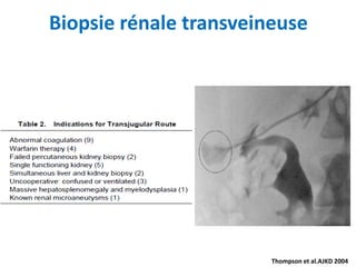 Biopsie rénale transveineuse
Thompson et al.AJKD 2004
 