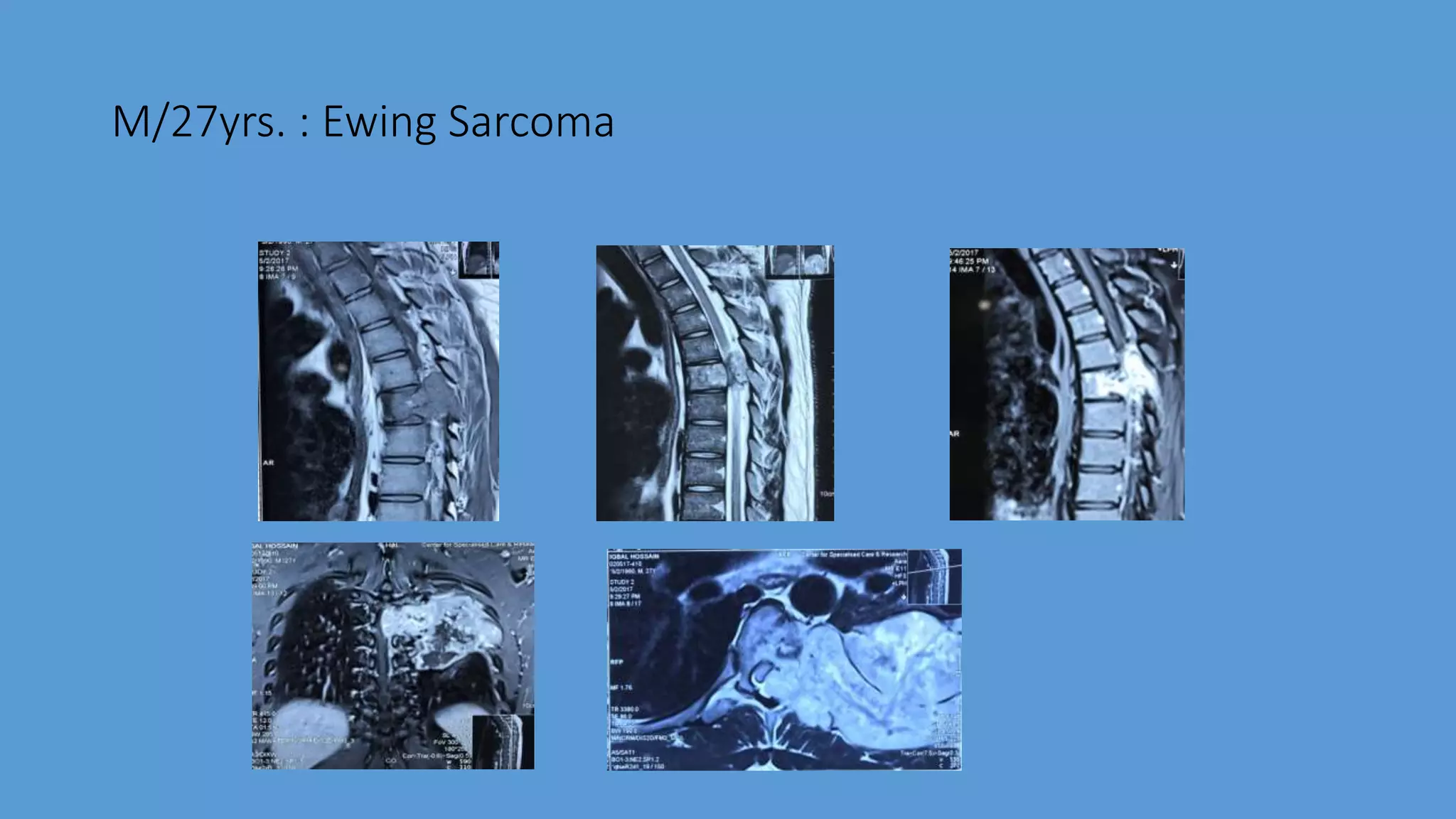 M/27yrs. : Ewing Sarcoma
 