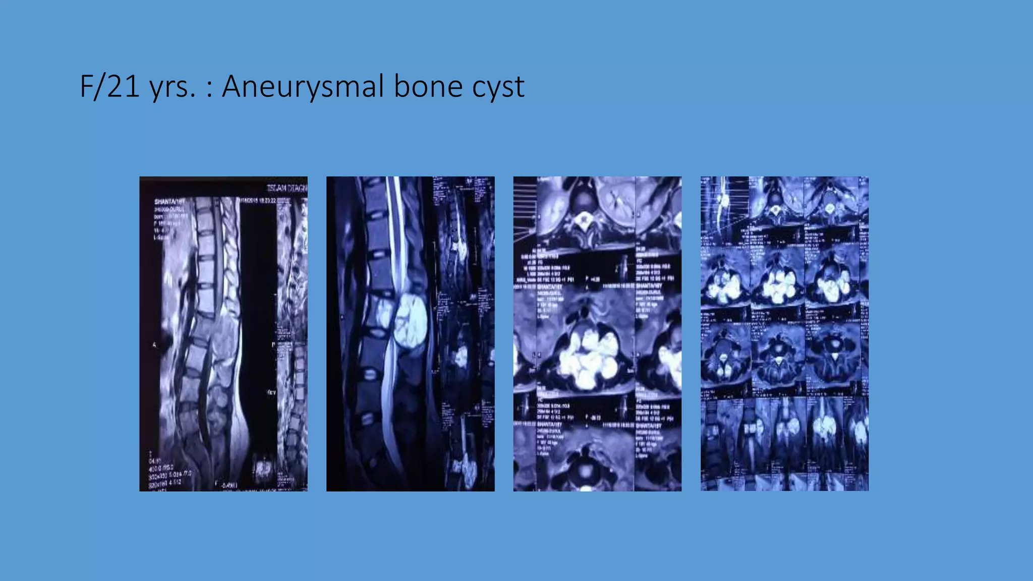 F/21 yrs. : Aneurysmal bone cyst
 