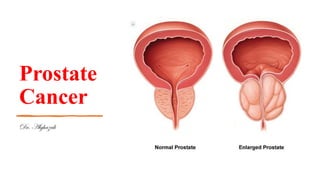Prostate
Cancer
Dr. Alghazali
 