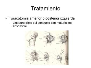 Tratamiento Toracotomia anterior o posterior izquierda Ligadura triple del conducto con material no absorbible  