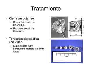 Tratamiento  Cierre percutaneo  Sombrilla doble de Rashkind Resortes o coil de Gianturco Toracoscopia asistida con video Clipaje: solo para conductos menores a 4mm largo 