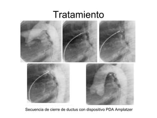 Tratamiento Secuencia de cierre de ductus con dispositivo PDA Amplatzer  