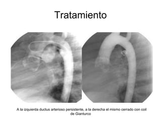 Tratamiento   A la izquierda ductus arterioso persistente, a la derecha el mismo cerrado con coil de Gianturco  