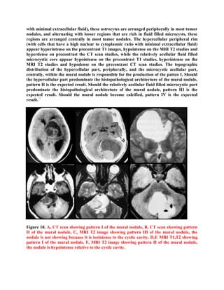 Topic of the month: Radiological pathology of pilocytic astrocytoma | PDF