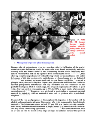 Topic of the month: Radiological pathology of pilocytic astrocytoma | PDF