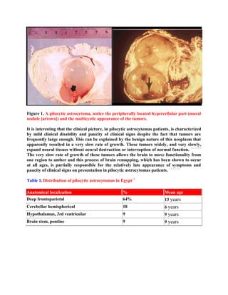 Topic of the month: Radiological pathology of pilocytic astrocytoma | PDF
