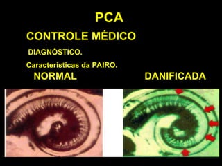 PCA
CONTROLE MÉDICO
DIAGNÓSTICO.
Características da PAIRO.
NORMAL
NORMAL DANIFICADA
DANIFICADA
 
