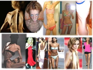 Necessidade de controlar aquilo que rodeia a pessoaAnorexia NervosaSinais/SintomasPsicológicos/Comportamentais