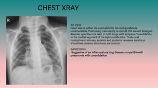 CHEST XRAY
AP VIEW
Heart size is within the normal limits. Its conﬁguration is
unremarkable. Pulmonary vascularity is normal. Hili are not enlarged.
Alveolar opacities are seen in both lungs with airspace consolidation
in the medial segment of the right middle lobe. The lateral
costophrenic sinuses, anterior and posterior recesses are sharp.
Visualized osseous structures are normal.
IMPRESSION:
Suggestive of an Inﬂammatory lung disease compatible with
pneumonia with consolidation.
 