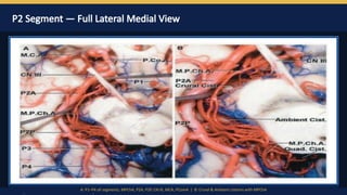 Pca Inervates PCA Surgical anatomy by Dr Prasanna D Hegde. Neurosurgery Resident ...