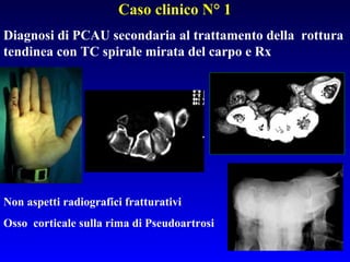 Caso clinico N° 1
Diagnosi di PCAU secondaria al trattamento della rottura
tendinea con TC spirale mirata del carpo e Rx

Non aspetti radiografici fratturativi
Osso corticale sulla rima di Pseudoartrosi

 