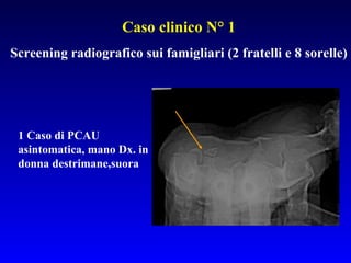 Caso clinico N° 1
Screening radiografico sui famigliari (2 fratelli e 8 sorelle)

1 Caso di PCAU
asintomatica, mano Dx. in
donna destrimane,suora

 