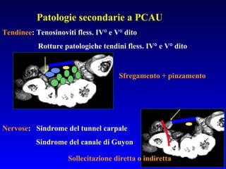 Patologie secondarie a PCAU
Tendinee: Tenosinoviti fless. IV° e V° dito
Rotture patologiche tendini fless. IV° e V° dito

Sfregamento + pinzamento

Nervose: Sindrome del tunnel carpale
Sindrome del canale di Guyon
Sollecitazione diretta o indiretta

 