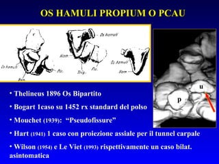 OS HAMULI PROPIUM O PCAU

•  Thelineus 1896 Os Bipartito
•  Bogart 1caso su 1452 rx standard del polso

u
p

•  Mouchet (1939): “Pseudofissure”
•  Hart (1941) 1 caso con proiezione assiale per il tunnel carpale
•  Wilson (1954) e Le Viet (1993) rispettivamente un caso bilat.
asintomatica

 