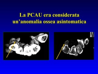 La PCAU era considerata
un’anomalia ossea asintomatica

 