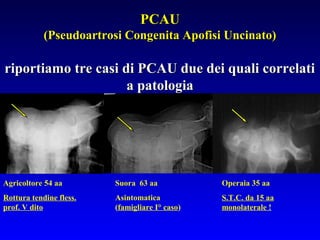 PCAU
(Pseudoartrosi Congenita Apofisi Uncinato)

riportiamo tre casi di PCAU due dei quali correlati
a patologia

Agricoltore 54 aa

Suora 63 aa

Operaia 35 aa

Rottura tendine fless.
prof. V dito

Asintomatica
(famigliare I° caso)

S.T.C. da 15 aa
monolaterale !

 