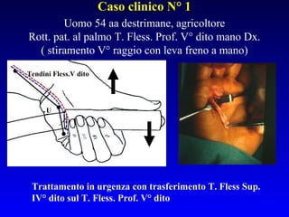 Caso clinico N° 1
Uomo 54 aa destrimane, agricoltore
Rott. pat. al palmo T. Fless. Prof. V° dito mano Dx.
( stiramento V° raggio con leva freno a mano)
Tendini Fless.V dito

U

Trattamento in urgenza con trasferimento T. Fless Sup. IV
° dito sul T. Fless. Prof. V° dito

 