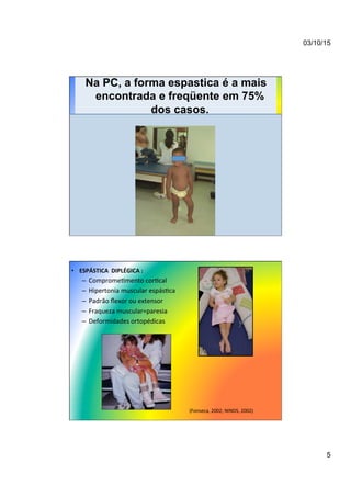 03/10/15
5
Na PC, a forma espastica é a mais
encontrada e freqüente em 75%
dos casos.
•  ESPÁSTICA	
  	
  DIPLÉGICA	
  :	
  
–  Comprome7mento	
  cor7cal	
  
–  Hipertonia	
  muscular	
  espás7ca	
  
–  Padrão	
  ﬂexor	
  ou	
  extensor	
  
–  Fraqueza	
  muscular=paresia	
  
–  Deformidades	
  ortopédicas	
  
(Fonseca,	
  2002;	
  NINDS,	
  2002)	
  
 