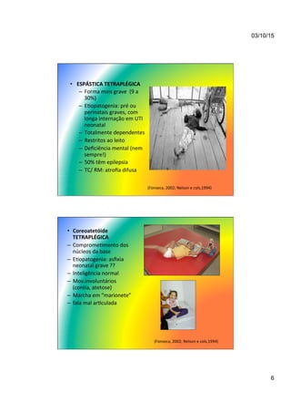 03/10/15
6
•  ESPÁSTICA	
  TETRAPLÉGICA	
  
–  Forma	
  mais	
  grave	
  	
  (9	
  a	
  
30%)	
  
–  E7opatogenia:	
  pré	
  ou	
  
perinatais	
  graves,	
  com	
  
longa	
  internação	
  em	
  UTI	
  
neonatal	
  
–  Totalmente	
  dependentes	
  
–  Restritos	
  ao	
  leito	
  
–  Deﬁciência	
  mental	
  (nem	
  
sempre!)	
  
–  50%	
  têm	
  epilepsia	
  
–  TC/	
  RM:	
  atroﬁa	
  difusa	
  
(Fonseca,	
  2002;	
  Nelson	
  e	
  cols,1994)	
  
•  Coreoatetóide	
  
TETRAPLÉGICA	
  
–  Comprome7mento	
  dos	
  
núcleos	
  da	
  base	
  
–  E7opatogenia:	
  asﬁxia	
  
neonatal	
  grave	
  ??	
  
–  Inteligência	
  normal	
  
–  Mov.involuntários	
  
(coréia,	
  atetose)	
  
–  Marcha	
  em	
  “marionete”	
  	
  
–  fala	
  mal	
  ar7culada	
  	
  
(Fonseca,	
  2002;	
  Nelson	
  e	
  cols,1994)	
  
 
