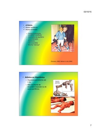 03/10/15
7
•  ATÁXICA:	
  
ü  Ataxia	
  ves7bular	
  
ü  Ataxia	
  cerebelar	
  
–  Comprome7mento	
  
cerebelar/	
  ves7bular	
  
–  Alterações	
  do	
  equilíbrio	
  
–  Incoordenação	
  
–  Hipotonia	
  
–  Fala	
  escandida	
  
–  Marcha	
  “ebriosa”	
  
	
  
(Fonseca,	
  2002;	
  Nelson	
  e	
  cols,1994)	
  
•  Atônica	
  ou	
  Hipotônica	
  
–  Hipotonia	
  persistente	
  até	
  
2-­‐3a	
  
–  Não	
  resultante	
  de	
  
desordem	
  muscular	
  ou	
  de	
  
nervo	
  periférico.	
  
 