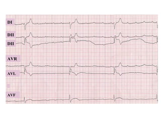 DII
DII
AVR
AVL
DI
AVF
 