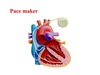 Pace maker
 