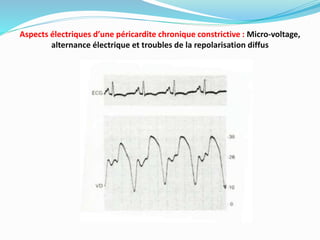 Aspects électriques d’une péricardite chronique constrictive : Micro-voltage,
alternance électrique et troubles de la repolarisation diffus
 