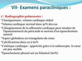 VII- Examens paracliniques :
2°- Radiographie pulmonaire :
*Classiquement, volume cardiaque réduit
*Volume cardiaque normal dans 50% des cas
*L’élargissement de la silhouette cardiaque peut résulter de
l’épaississement du péricarde et surtout d’un épanchement
associé
*Aspect globuleux ou triangulaire du cœur
*Calcifications dans 20 à 60%
*Cinétique cardiaque : appréciée grâce à la radioscopie, le cœur
est peu mobile
*Epanchement pleural uni ou bilatéral (60%)
 