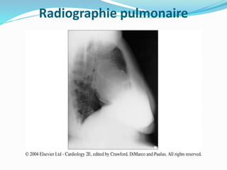 Radiographie pulmonaire
 