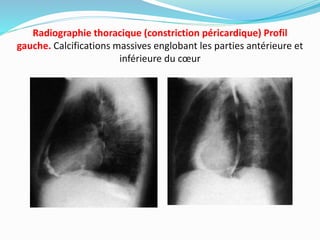 Radiographie thoracique (constriction péricardique) Profil
gauche. Calcifications massives englobant les parties antérieure et
inférieure du cœur
 