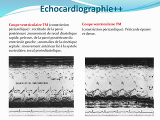Echocardiographie++
Coupe ventriculaire TM (constriction
péricardique) : rectitude de la paroi
postérieure ;mouvement de recul diastolique
rapide, précoce, de la paroi postérieure du
ventricule gauche ; anomalies de la cinétique
septale : mouvement antérieur lié à la systole
auriculaire; recul protodiastolique.
Coupe ventriculaire TM
(constriction péricardique). Péricarde épaissi
et dense.
 
