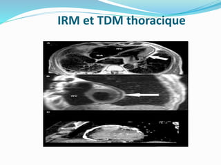 IRM et TDM thoracique
 