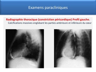 Examens paracliniques
Radiographie thoracique (constriction péricardique) Profil gauche.
Calcifications massives englobant les parties antérieure et inférieure du cœur
 