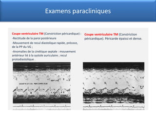 Coupe ventriculaire TM (Constriction péricardique) :
-Rectitude de la paroi postérieure
-Mouvement de recul diastolique rapide, précoce,
de la PP du VG ;
-Anomalies de la cinétique septale : mouvement
antérieur lié à la systole auriculaire ; recul
protodiastolique .
Coupe ventriculaire TM (Constriction
péricardique). Péricarde épaissi et dense.
Examens paracliniques
 
