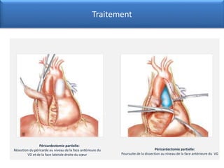 Traitement
Péricardectomie partielle:
Résection du péricarde au niveau de la face antérieure du
VD et de la face latérale droite du cœur
Péricardectomie partielle:
Poursuite de la dissection au niveau de la face antérieure du VG
 