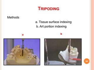 Surveying and Designing in Cast Partial Denture | PPT