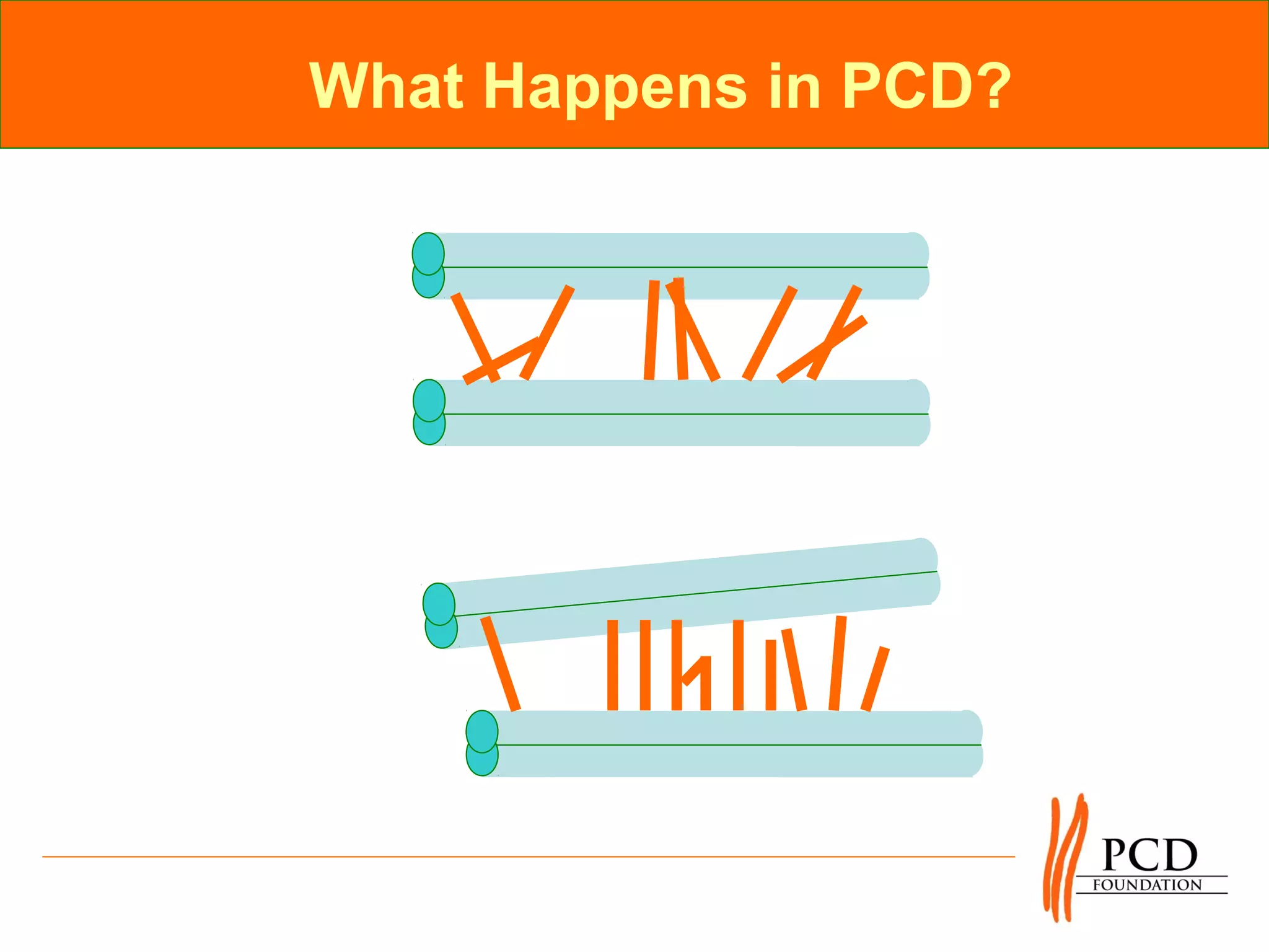 What Happens in PCD?
 