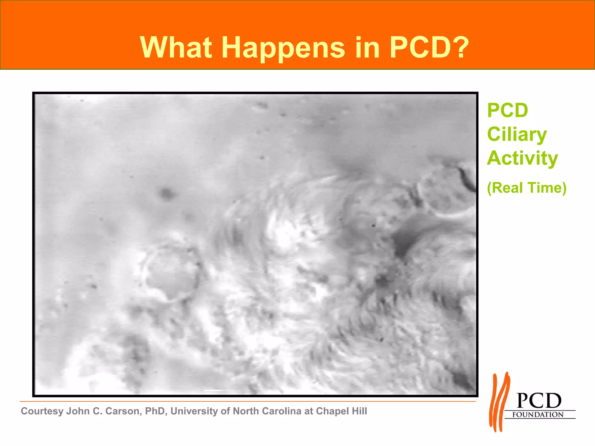 What Happens in PCD?

                                                                            PCD
                                                                            Ciliary
                                                                            Activity
                                                                            (Real Time)




Courtesy John C. Carson, PhD, University of North Carolina at Chapel Hill
 