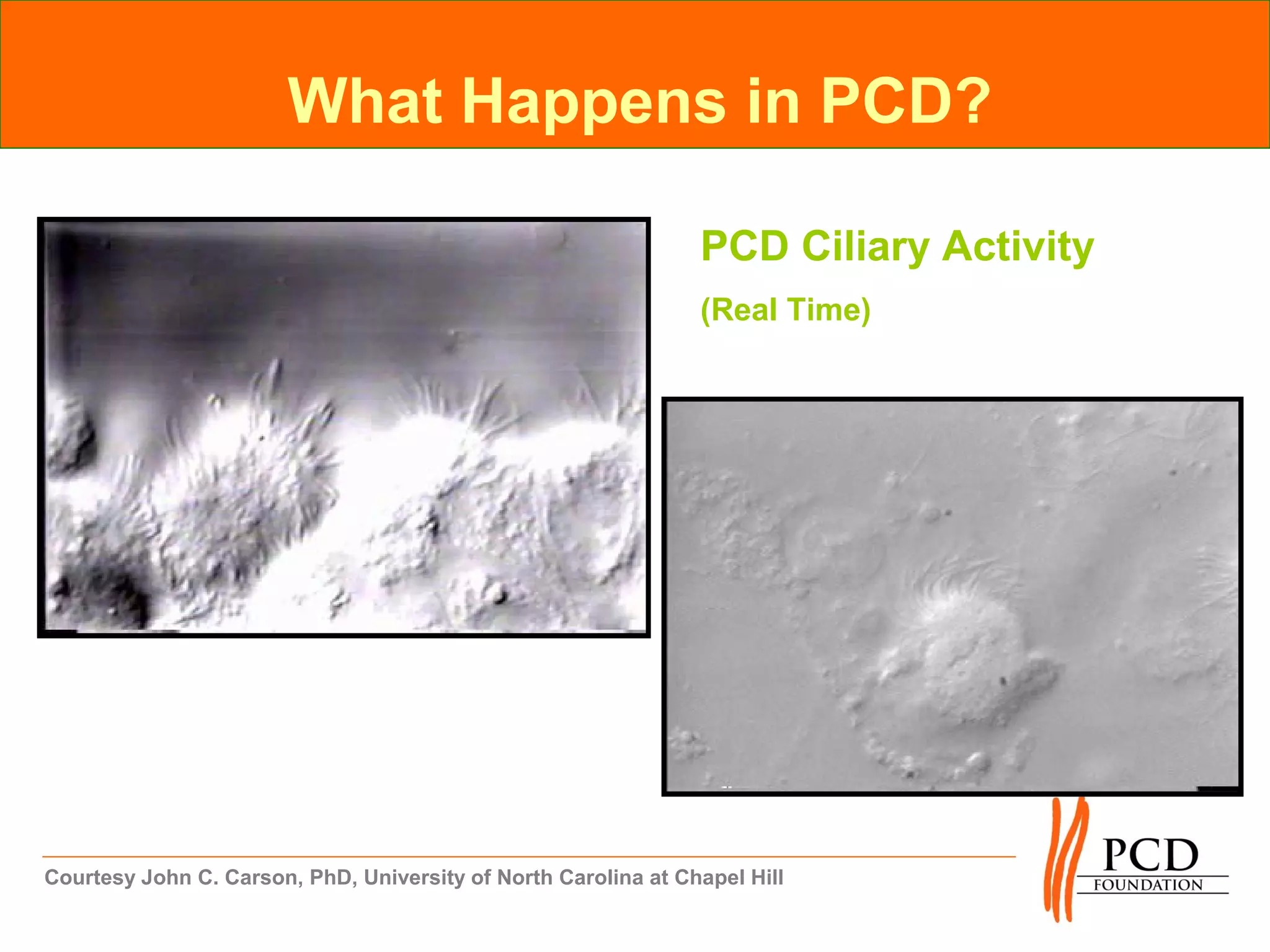 What Happens in PCD?

                                                                PCD Ciliary Activity
                                                                (Real Time)




Courtesy John C. Carson, PhD, University of North Carolina at Chapel Hill
 