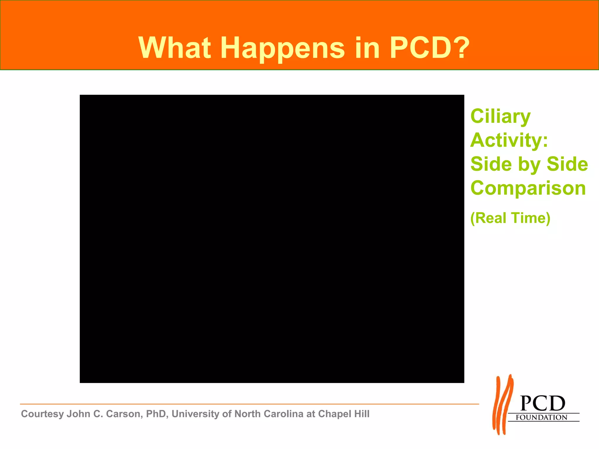 What Happens in PCD?

                                                                            Ciliary
                                                                            Activity:
                                                                            Side by Side
                                                                            Comparison
                                                                            (Real Time)




Courtesy John C. Carson, PhD, University of North Carolina at Chapel Hill
 