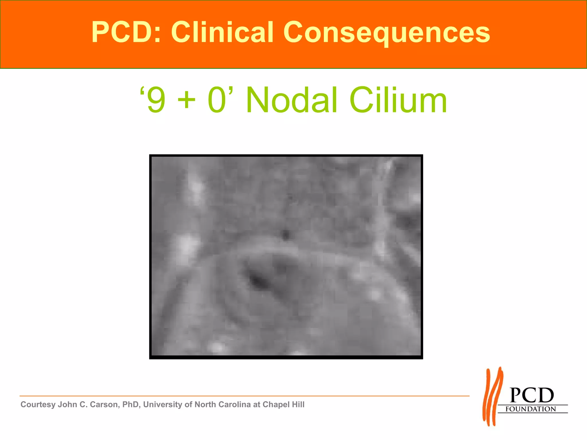 PCD: Clinical Consequences

                              ‘9 + 0’ Nodal Cilium




Courtesy John C. Carson, PhD, University of North Carolina at Chapel Hill
 