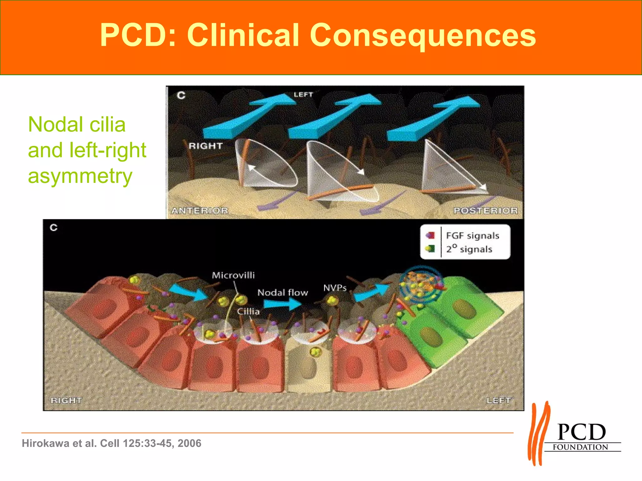 PCD: Clinical Consequences

 Nodal cilia
 and left-right
 asymmetry




Hirokawa et al. Cell 125:33-45, 2006
 
