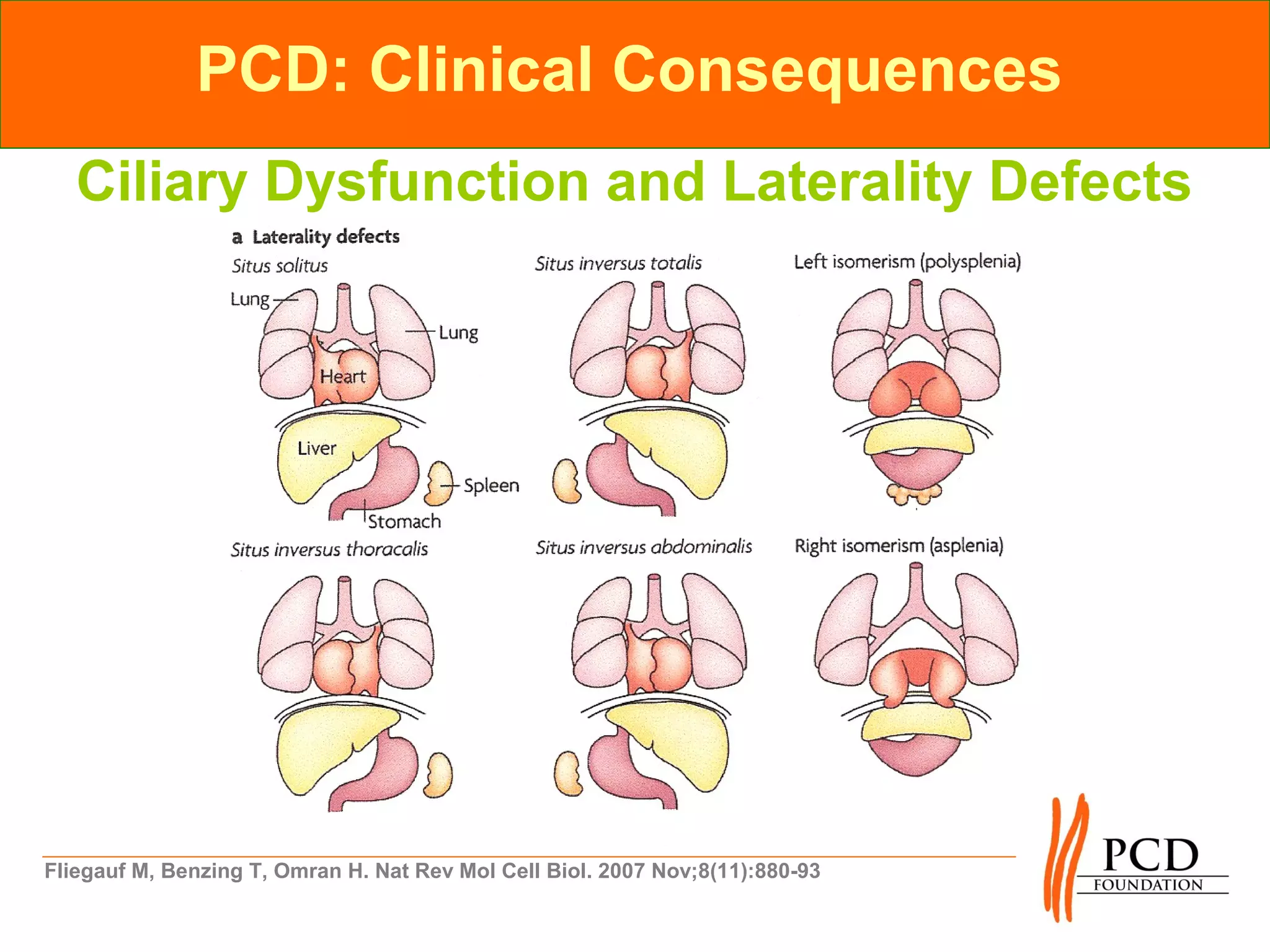 PCD: Clinical Consequences
   Ciliary Dysfunction and Laterality Defects




Fliegauf M, Benzing T, Omran H. Nat Rev Mol Cell Biol. 2007 Nov;8(11):880-93
 
