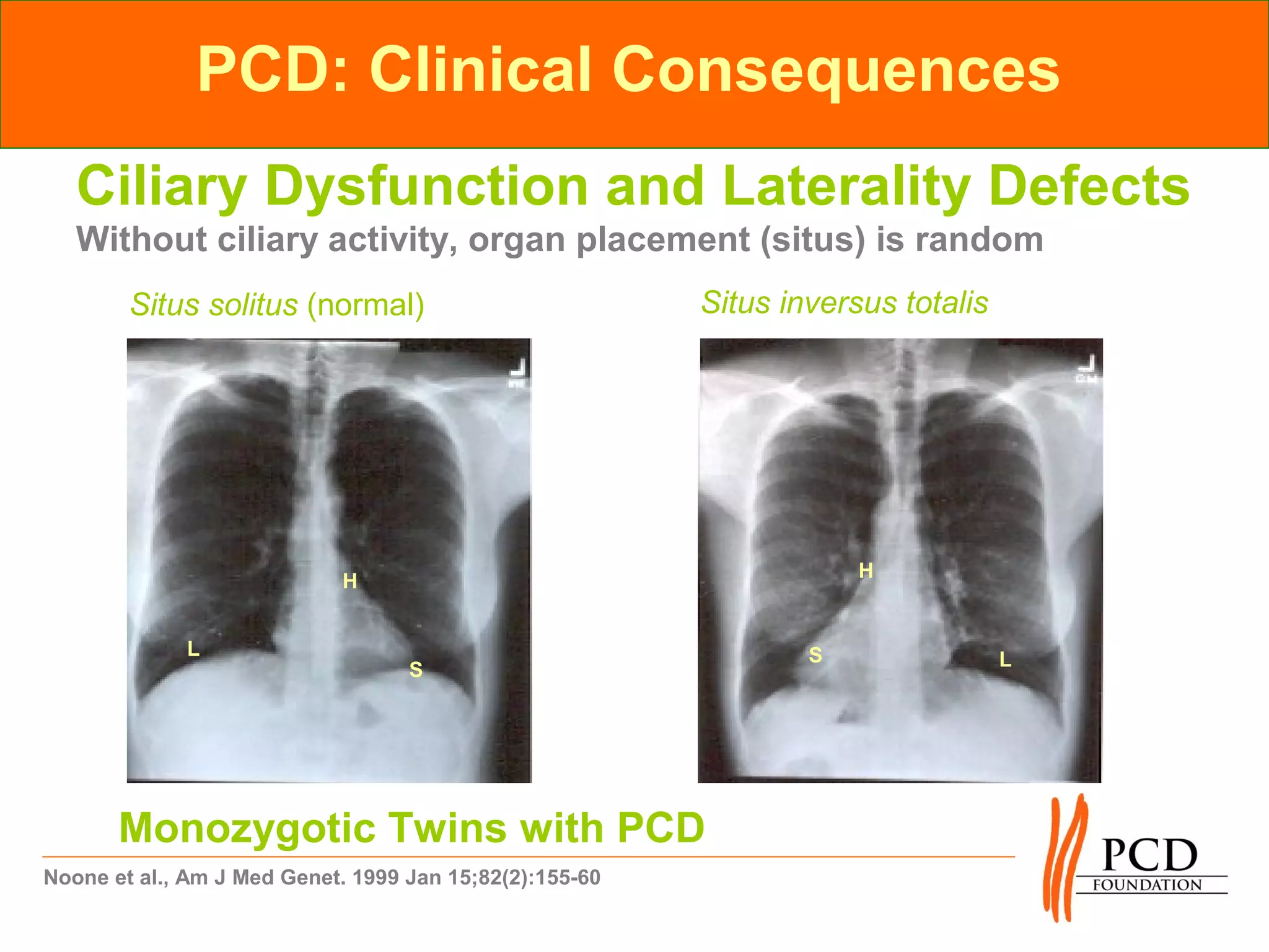 PCD: Clinical Consequences
   Ciliary Dysfunction and Laterality Defects
   Without ciliary activity, organ placement (situs) is random
        Situs solitus (normal)                           Situs inversus totalis




                                                  L
                                                                     H
                            H


             L                                                   S
                                   S                                              L




       Monozygotic Twins with PCD
Noone et al., Am J Med Genet. 1999 Jan 15;82(2):155-60
 