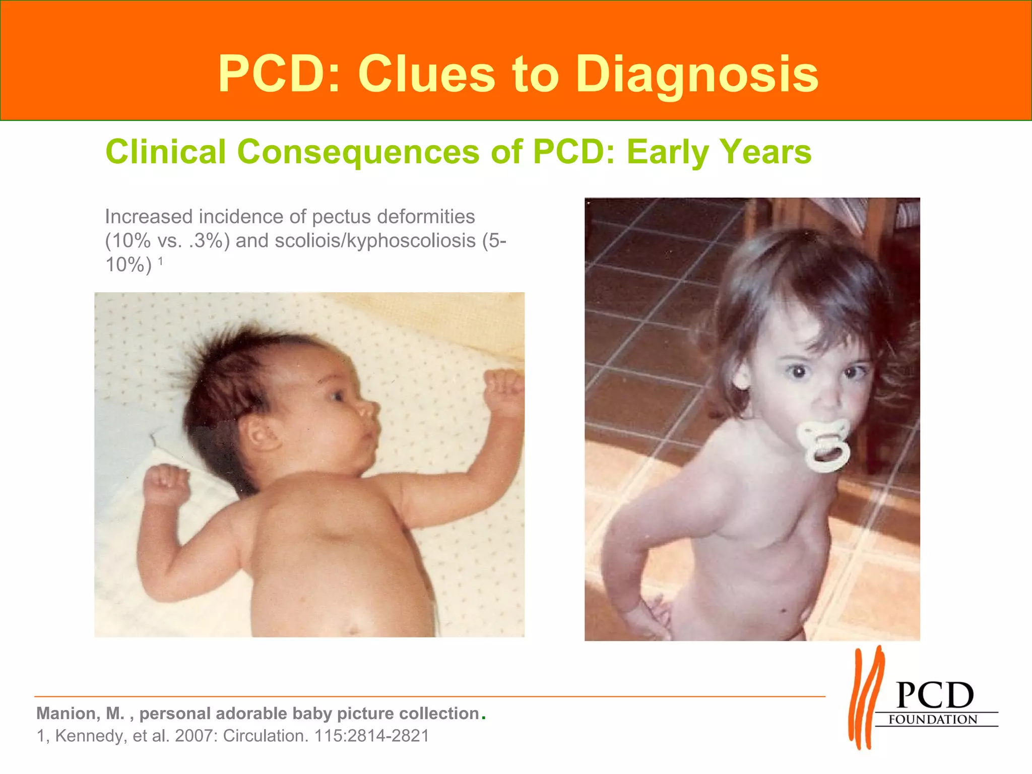 PCD: Clues to Diagnosis
        Clinical Consequences of PCD: Early Years
        Increased incidence of pectus deformities
        (10% vs. .3%) and scoliois/kyphoscoliosis (5-
        10%) 1




Manion, M. , personal adorable baby picture collection .
1, Kennedy, et al. 2007: Circulation. 115:2814-2821
 