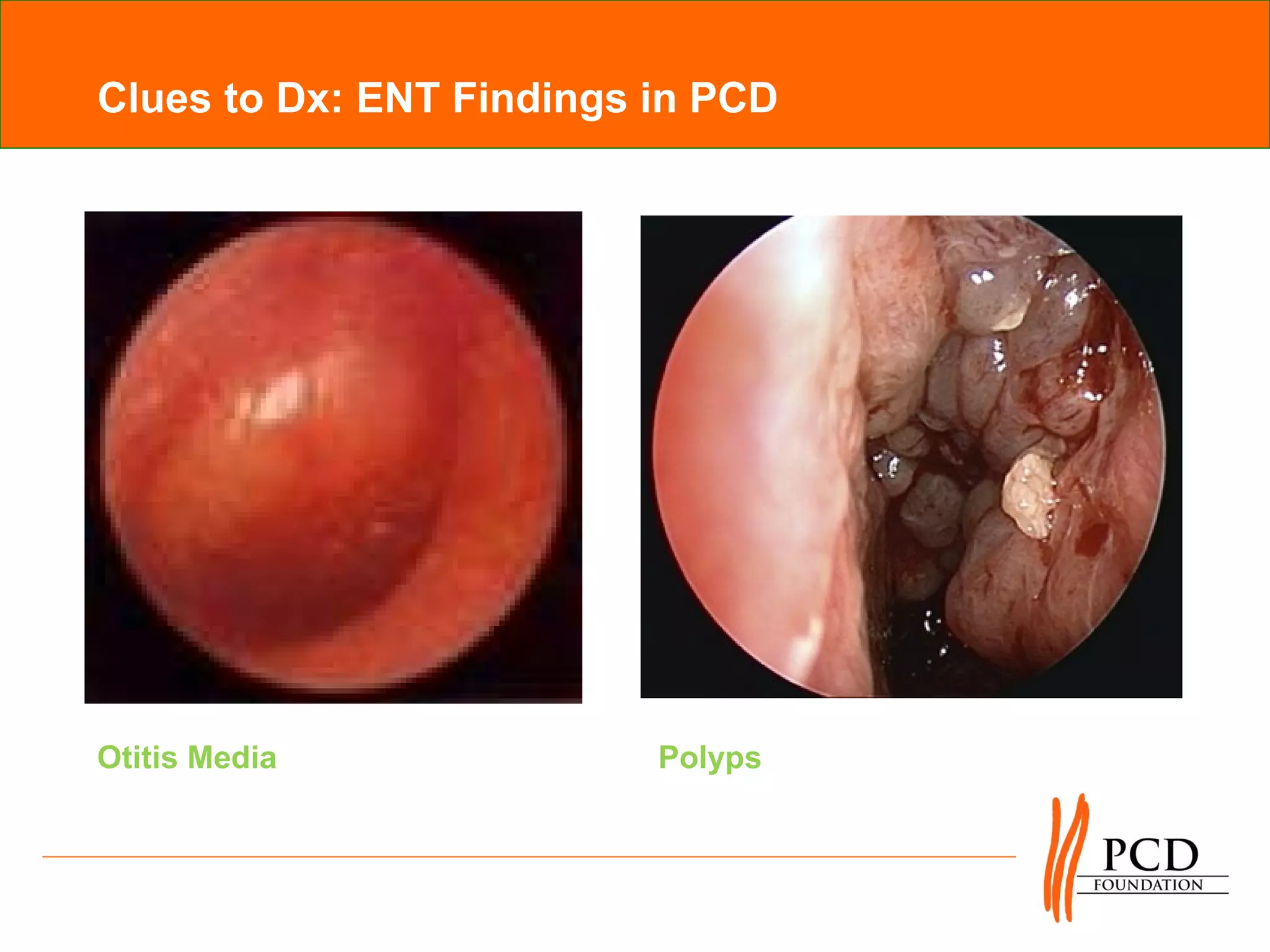 Clues to Dx: ENT Findings in PCD




Otitis Media              Polyps
 