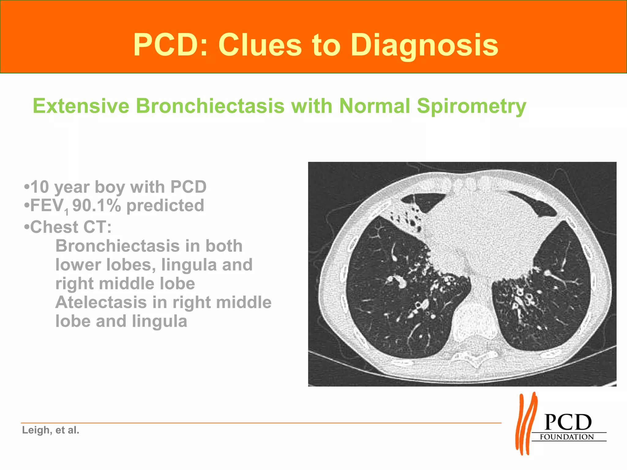 PCD: Clues to Diagnosis
  Extensive Bronchiectasis with Normal Spirometry


•10 year boy with PCD
•FEV1 90.1% predicted
•Chest CT:
    Bronchiectasis in both
    lower lobes, lingula and
    right middle lobe
    Atelectasis in right middle
    lobe and lingula




Leigh, et al.
 