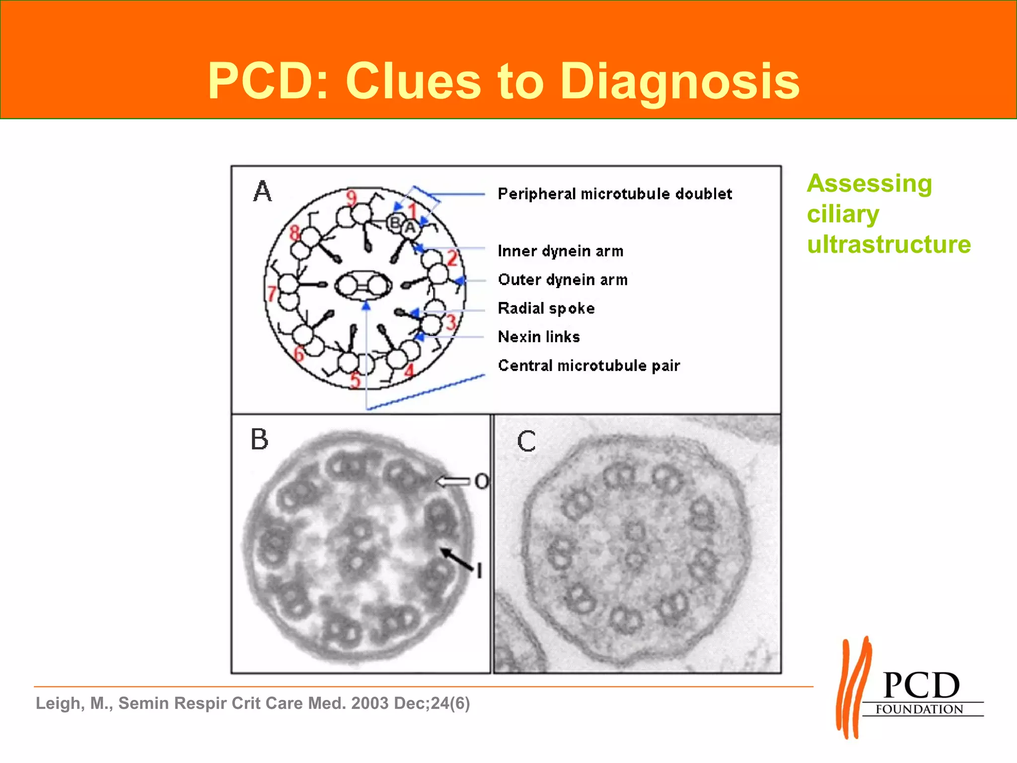 PCD: Clues to Diagnosis
                                                        Assessing
                                                        ciliary
                                                        ultrastructure




Leigh, M., Semin Respir Crit Care Med. 2003 Dec;24(6)
 