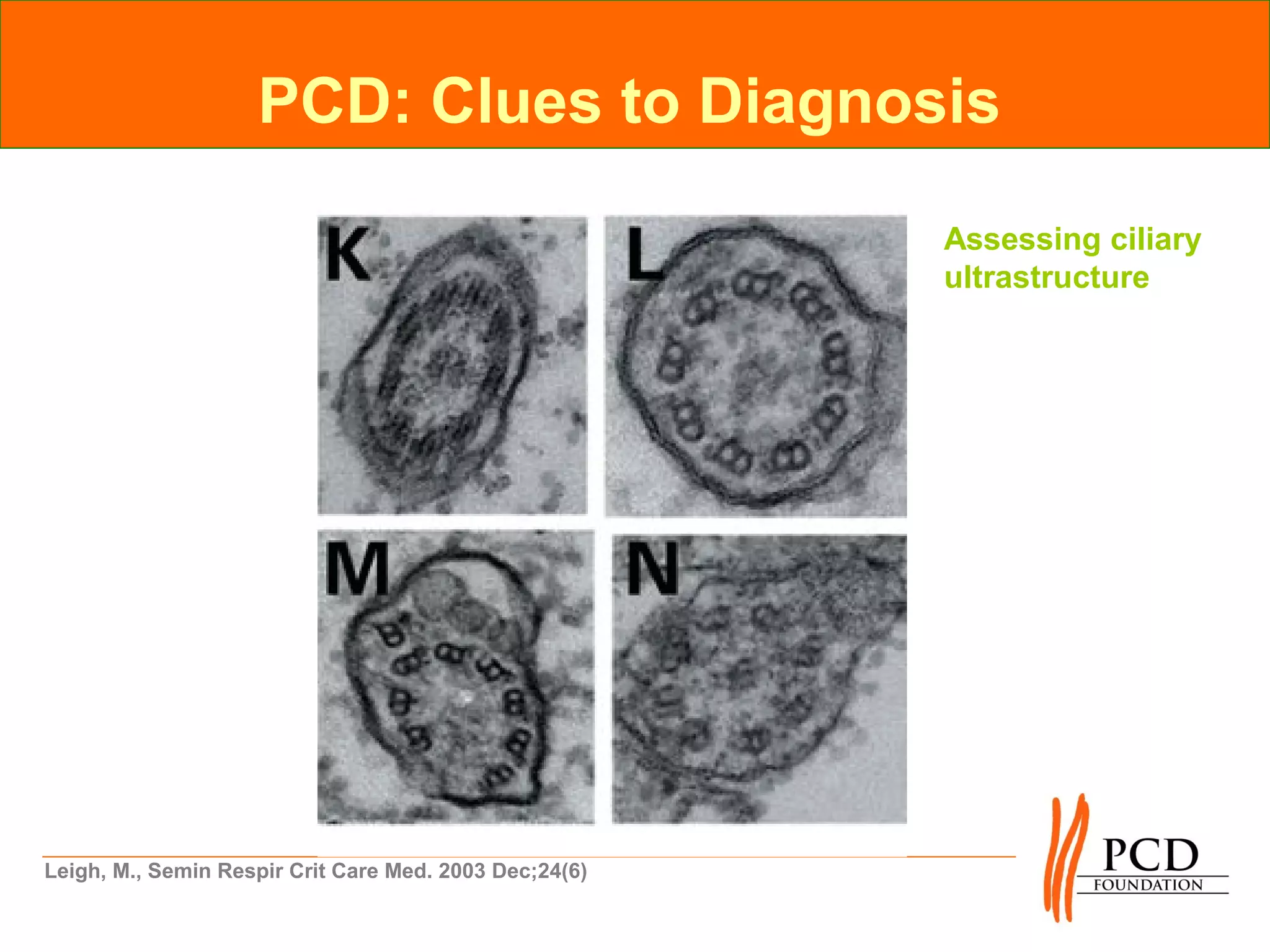 PCD: Clues to Diagnosis

                                                        Assessing ciliary
                                                        ultrastructure




Leigh, M., Semin Respir Crit Care Med. 2003 Dec;24(6)
 